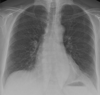 Aortopulmonella