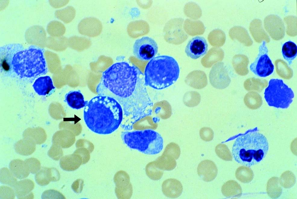 6(7) Det är vanligt med icke fungerande Romanowsky-metoder [2]. Avsaknaden av kontrast mellan kärna, granula och cytoplasma vid misslyckad färgning försvårar klassifikationen.