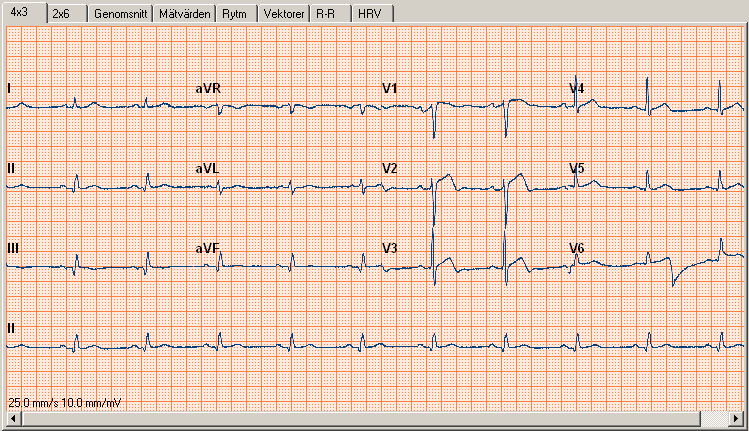 Så här lägger du till kommentarer: 1. Skriv in dina kommentarer i fönstret Information. 2. Klicka på OK så sparas dina kommentarer. 4.2 Vyer Welch Allyn Cardio Perfect har olika vyer för ett EKG.
