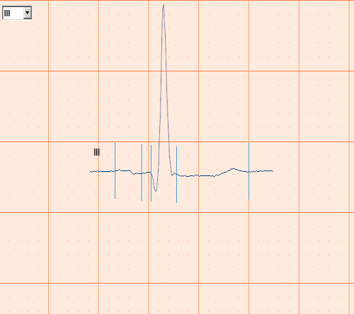 Welch Allyn Cardio Perfect har ett stort utbud av hastigheter och sensitivitetsnivåer. Du kan justera EKG-skalan genom att justera hastigheten och sensitiviteten.