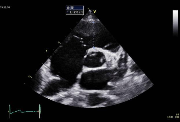 6 (13) A B C RVD3 RVD2 RVD1 Figur 5: Vanligaste måtten avseende högerkammaren. A: SAX: höger kammares utflödesdiameter, RVOT1 (RVOT2 ej tydligt visualiserad).