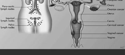 Corpuscancer ca 1325 Ovarialcancer ca 785 Borderline 222 Cervixcancer ca 439 Vulvacancer ca 129