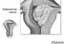 Främst Postmenopausala kvinnor Medianålder 64 år Tredje vanligast cancerformen hos kvinnor Inga graviditeter Sen menopaus Övervikt Östrogensubstitution utan gestagentillägg