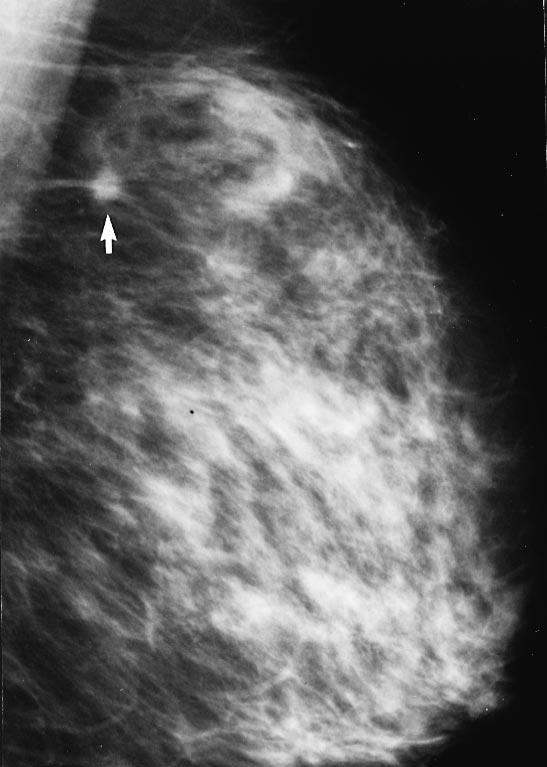 K SK Figur 1a. Mammografibild av vänster bröst. Vid pilen ses en 5 mm stor cancermisstänkt förändring. Figur 1b. Mammografi tre år senare, då patienten känt en knuta i bröstet.