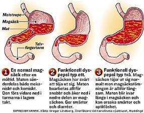 Mag- tarmdiagnoser: Diagnos Beskrivning Symptom Dyspepsi Dyspepsi kan ha flera orsaker.