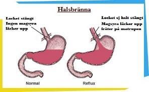 Mag- tarmdiagnoser: Diagnos Beskrivning Symptom Reflux Halsbränna Reflux betyder återflöde och innebär att den övre magmunnen inte kan hålla helt tätt utan släpper igenom en del magsaft från