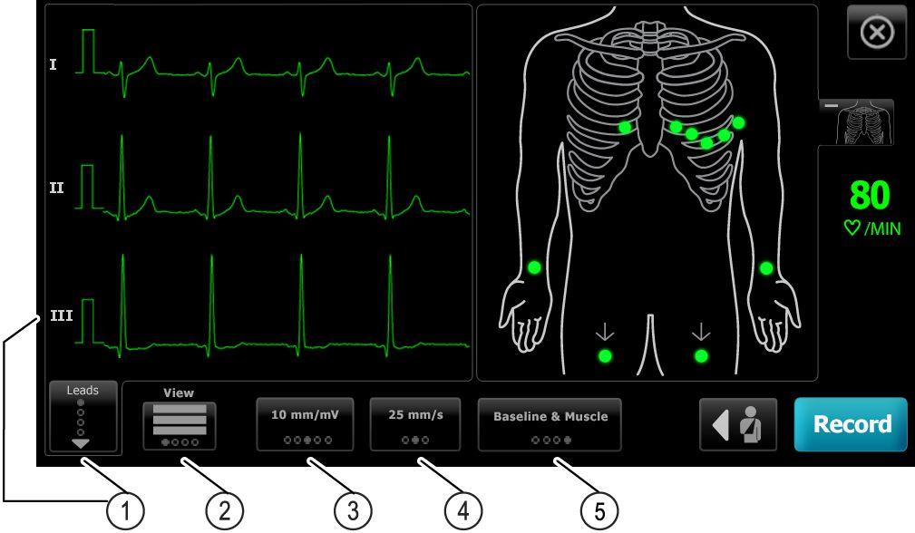 8 EKG-undersökningar CP 150 EKG-apparat med 12 avledningar för vilo-ekg Läkare. Tryck på OK. Kommentarer. Tryck på OK. 5. Fäst avledningarna på patienten. 6.