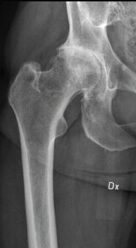 Ya Xia VT- 14 med diagnstiserad artrs i knä blir aktuellt först då symptmen på artrs inte svarar på behandling eller då det finns behv av att utesluta annan sjukdm sm rsak till knäsmärta ch