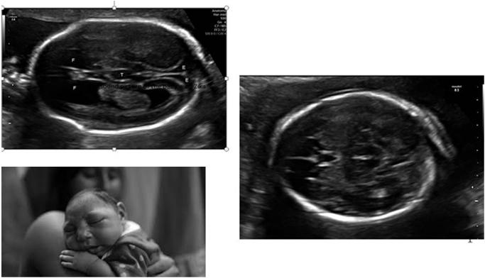 Vidare utredning hos gravid Handläggning på spec-mvc Fostervattenprov med PCR (> 6-7 v efter infektion och >18-20 graviditetsveckor) Ultraljud/MR- vad kan man se? Hur ofta skall det göras?