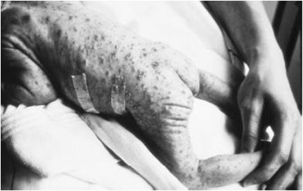 1999-2015 <0,5 % Herpes simplexinfektion Herpes genitalis Seroprevalens