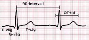 QT-tiden representerar kamrarnas de- och repolarisation, och är normalt <0,45 s [7], korrigerad för hjärtfrekvensen med Bazetts formel. Neonatalt kan den vara längre, men bör då omkontrolleras [3].