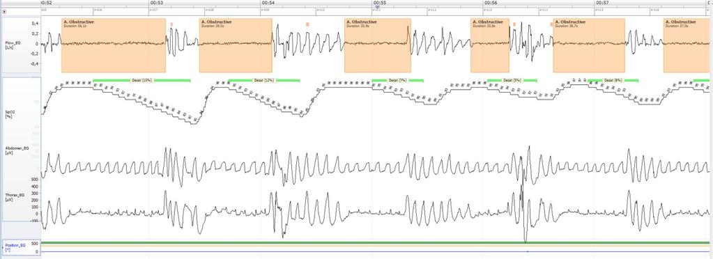 Typexempel på OSA-registrering Här presenteras sex minuter av en femkanalsregistrering.