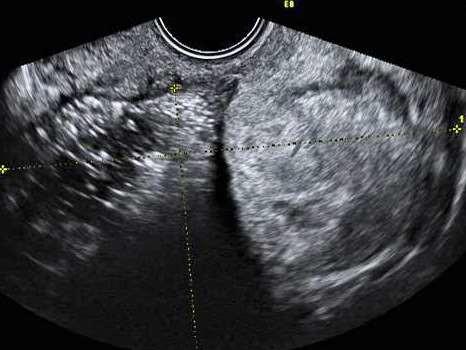 Bild 2. Struma Ovarii, notera hyperekogen solid vävnad till höger I bild. Bild 3. Omoget teratom, notera oregelbunden struktur.