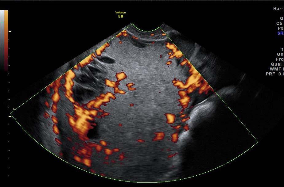 Bild 4 Gulesäckstumör, Yolksac tumor/ Endodermal sinus tumor, hos 25-årig patient som sökt p.g.a. blödningsrubbningar, förhöjt AFP.