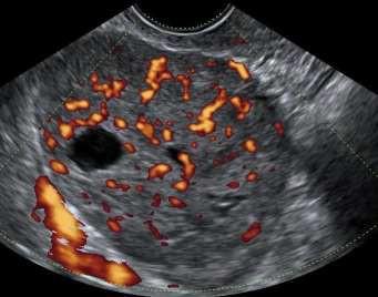 Bild 5. Granulosacellstumör hos 30 årig kvinna med blödningsrubbningar och infertilitet Fibrom fibrotekom tekom Fibrom är den vanligaste benigna könssträngs-stromacellstumören8.