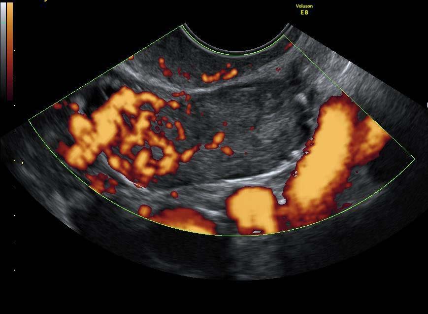 Förekommer hos kvinnor i alla åldrar, ger ofta endokrina symptom. I en serie på 23 patienter fann man att tumören var helt solid i 60 % av fallen och innehöll en solid komponent i 96 % av fallen5.