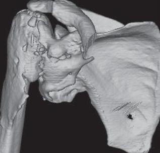 skadorbrännskada Trauma Incidens 10-20% vid