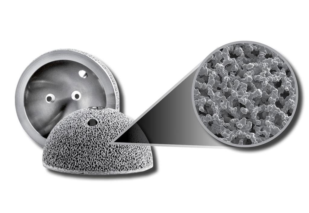 Implantat tillverkas industriellt med 3D-printer Titanmaterialet och ytstrukturen efter tillverkning är perfekta för implantat Specifik anpassning till användaren Kostnaden är