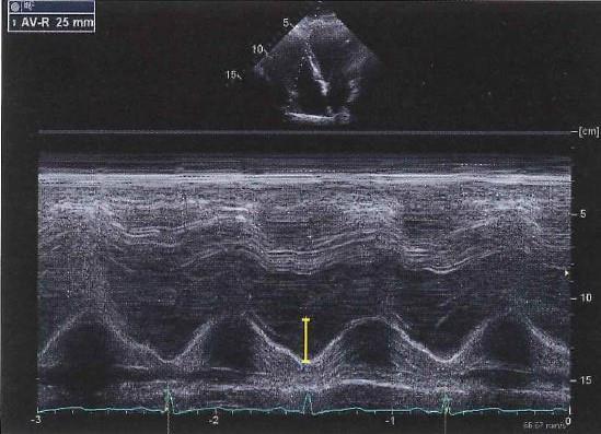 Figur 3 visar M-mode registrering över annulus tricuspidalis, Tricuspid Annular Plane Systolic Excursion (TAPSE). Mätningen sker från slutdiastole till slutsystole.