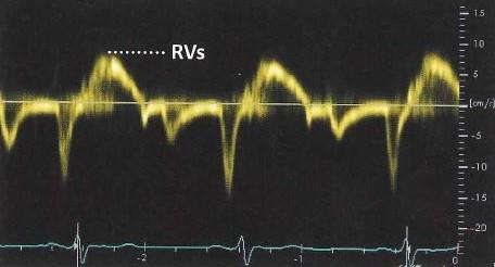 Högerkammarfunktion mätt med s s mäts med TDI som är en form av pulsad doppler som registrerar myokardiets hastighet, se figur 4. s infaller vid QRS-komplexet i elektrokardiografi (EKG).