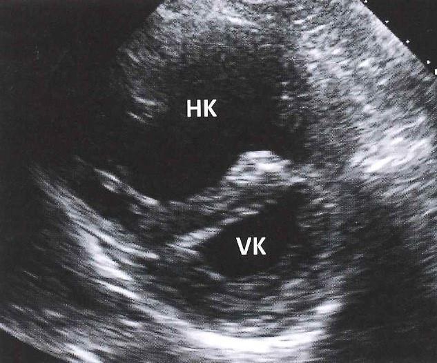 Sjukdomar som påverkar höger kammare PAH kännetecknas av högt tryck i lungkretsloppet som fortplantas till höger kammare. PAH beror på ökad pulmonell vaskulär resistens.