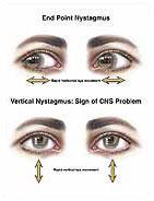 Central Nystagmus Kan vara horisontell, vertikal eller torsionell Kan ändra riktning