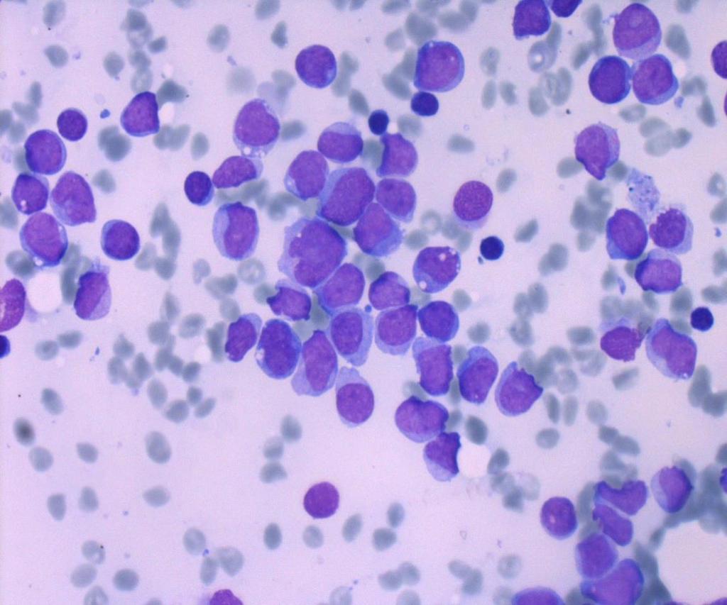 Akut myelomonocytär leukemi 5-10% av AML 20% blaster &