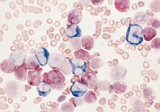 monocyter&prekursorer i BM Ibland hög monocytos i PB Flera