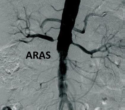 (FMD), 10% FMD Ovanliga orsaker: aortorenal