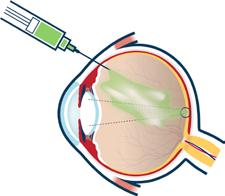 Behandling Det går att behandla diabetisk retinopati och diabetiskt makulaödem.