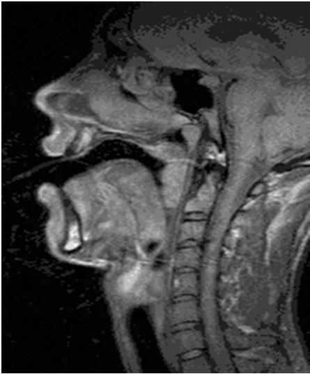 Numerical modelling of the non-vibratory biomechanics of human voice production Build a slow 3D model of the biomechanisms that define the shape of the larynx and the oropharyngeal tract: vocal