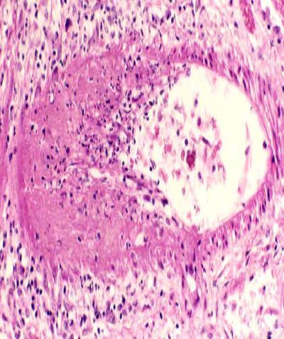 Pauci-immune (ANCA) småkärlsvaskulit
