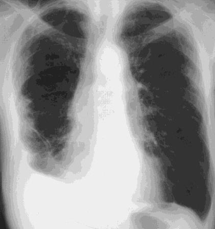 Pneumoni, behandlingstid
