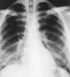 Pneumonidiagnos: