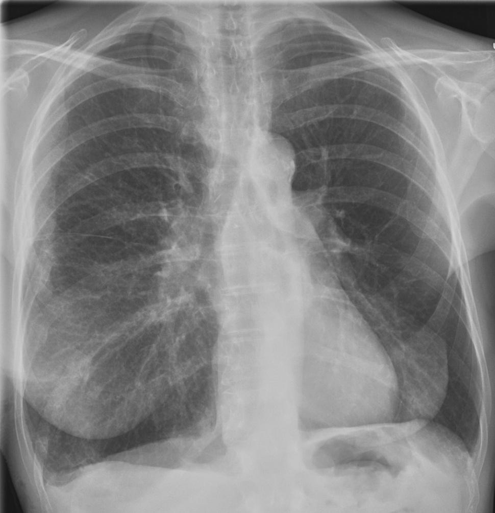 Pneumothorax,