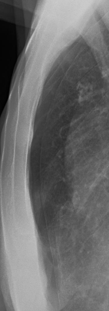 Pneumothorax,