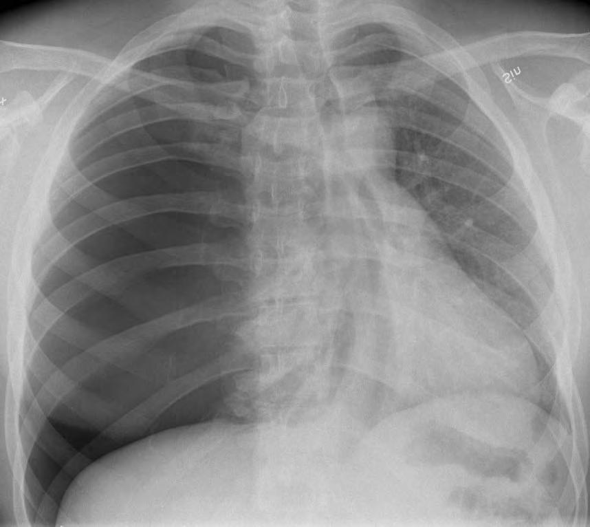 Ventilpneumothorax Livshotande!