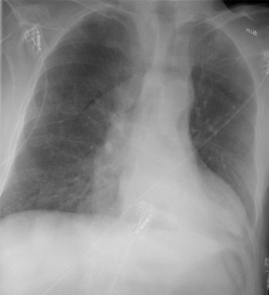 Fallgrop, ej pneumothorax