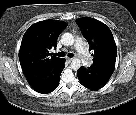 Aortopulmonella fönstret Tumor