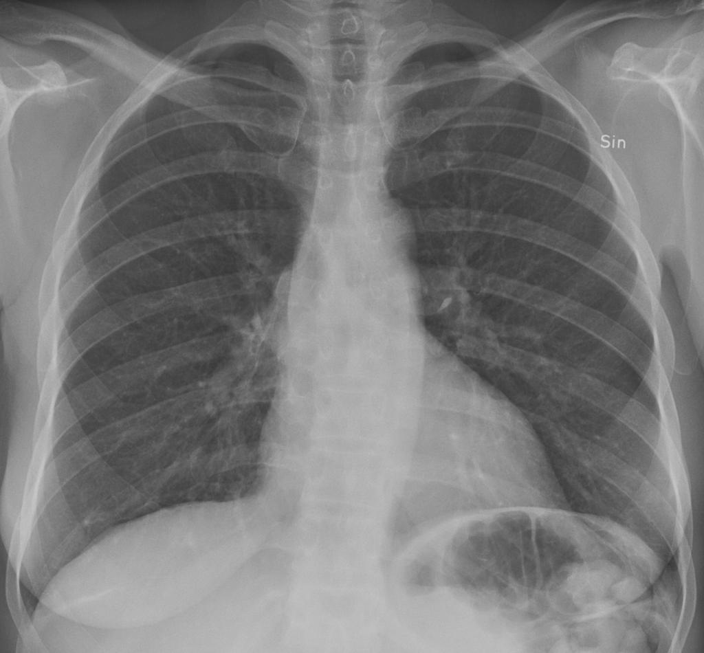 2. Diafragma Normala lungor 6:e revbenet vid broskbengränsen