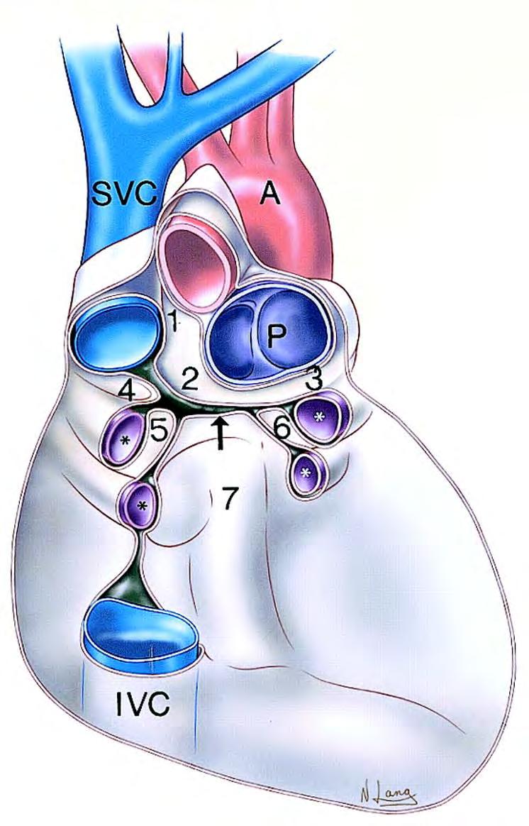 Pericardiac recesses 1. Superior aortic recess 2. Right Pulmonic recess of transverse sinus 3.