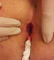 Förbättrad förslutning med RENASYS Adhesive Gel Patch på kanten mot anus. Första bytet efter tre dagar. Efter en vecka: såret läker fint.