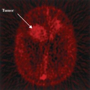 Val av märkningsposition Exempel: [ 11 C]Temozolomide A Synthesis 11 C-labelled temozolomide B PET study with compound A showed tumor uptake.