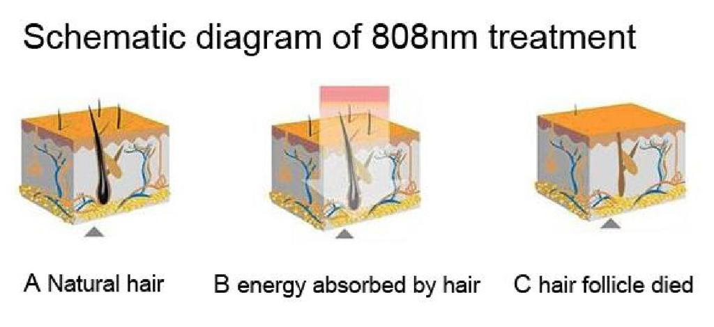 Fördelar & Egenskaper Multi-Wave Diodlaser gör det möjligt för ljuset att tränga djupare in i huden och är säkrare än andra lasrar eftersom det kan undvika melanin pigment i hudens epidermis.