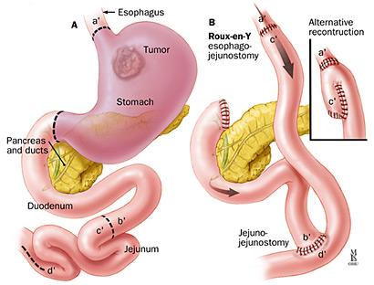 Viktnedgång alarmsymptom. Diarré Rapningar Kräkningar alarmsymptom. Alarmsymptomen måste utredas! Diagnostik Gastroskopi! Vid misstanke om esofagus- /cardiacancer och ventrikelcancer.