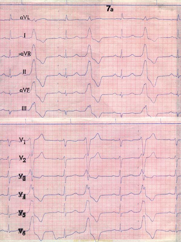 EKG 1