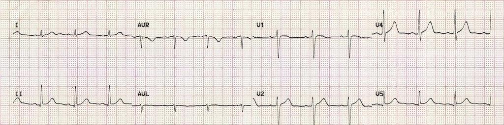 EKG 3