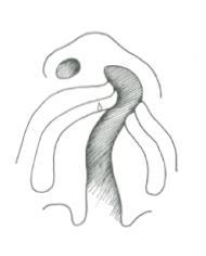 a) b) c) d) Figur 1. a) Unilateral läpp-käk-gomspalt (LKG) sedd underifrån. b) Bilateral LKG. c) Isolerad gomspalt. d) Partiell gomspalt. Illustration av Liisi Raud Westberg.