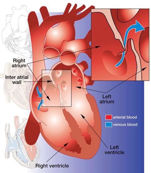 Paradoxal embolisering PFO