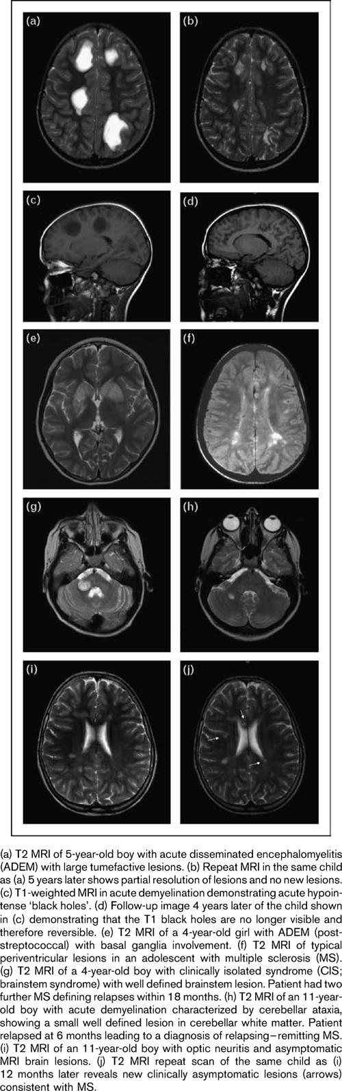 MR bra biomarkör vid neuroinflammatoriska tillstnd